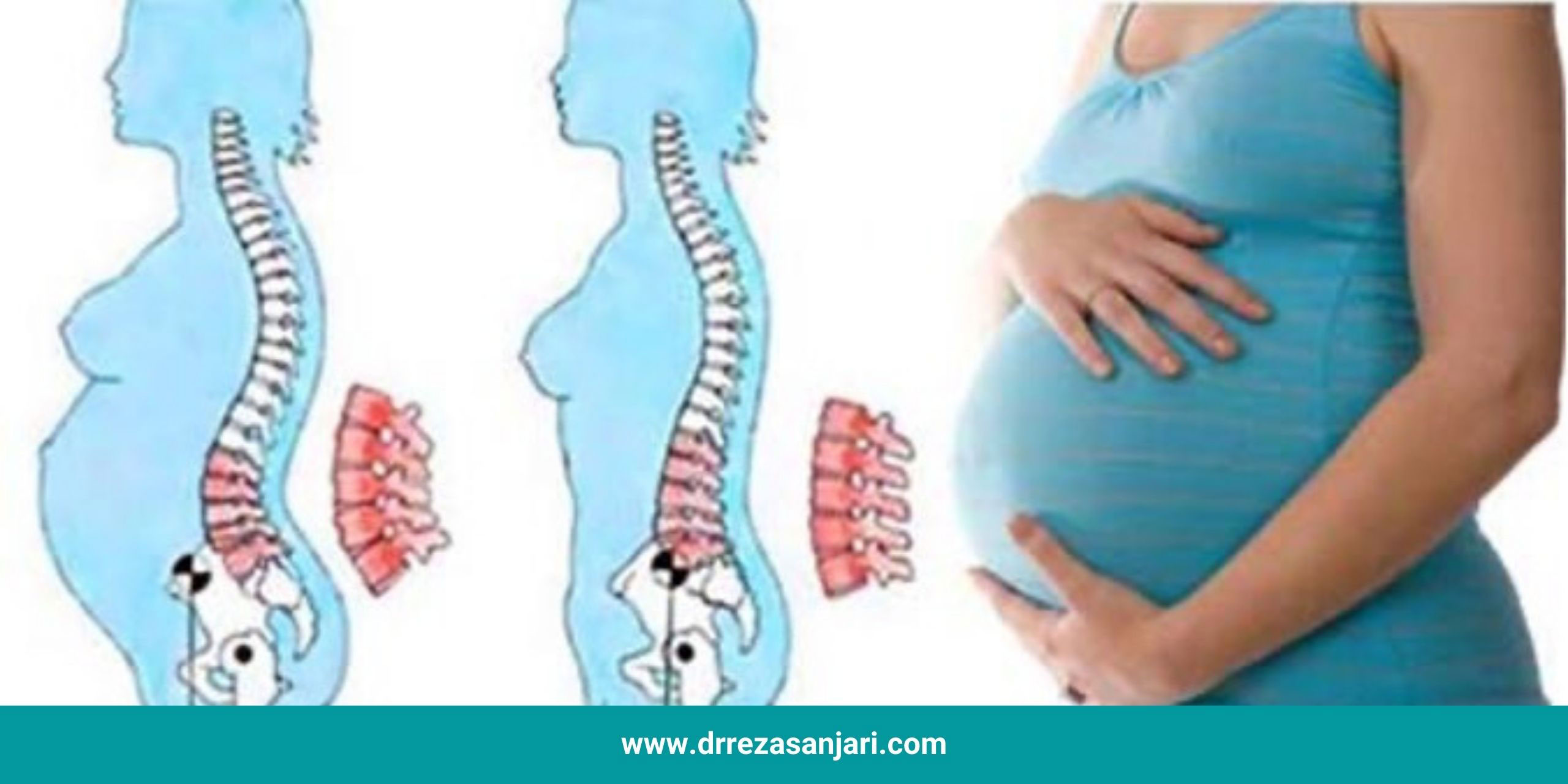 راه های پیشگیرانه درد سیاتیک در بارداری 